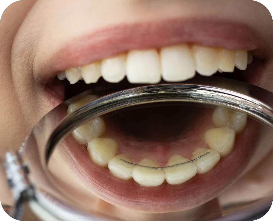 contention simeoni castelnau le lez contention simeoni castelnau le lez Multi-bagues Cabinet d'orthodontie du Dr SIMEONI