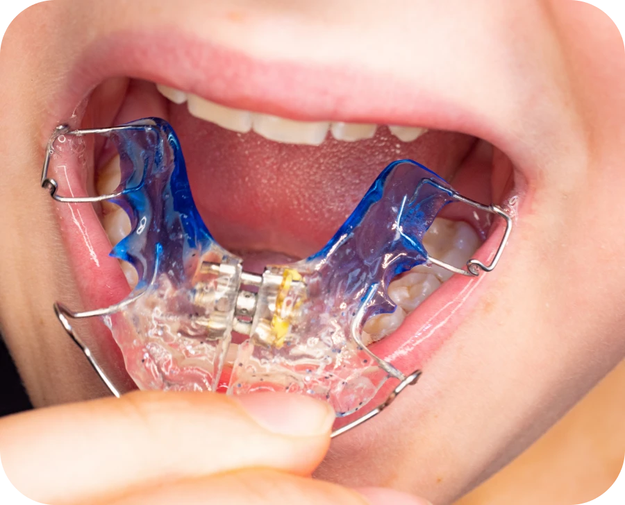 traitement interceptif castelnau le lez traitement interceptif castelnau le lez Plaque palatine Cabinet d'orthodontie du Dr SIMEONI