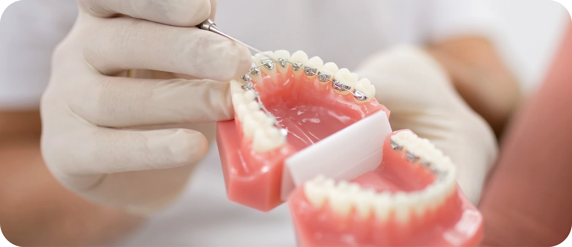 traitement lingual castelnau le lez traitement lingual castelnau le lez Orthodontie linguale Cabinet d'orthodontie du Dr SIMEONI