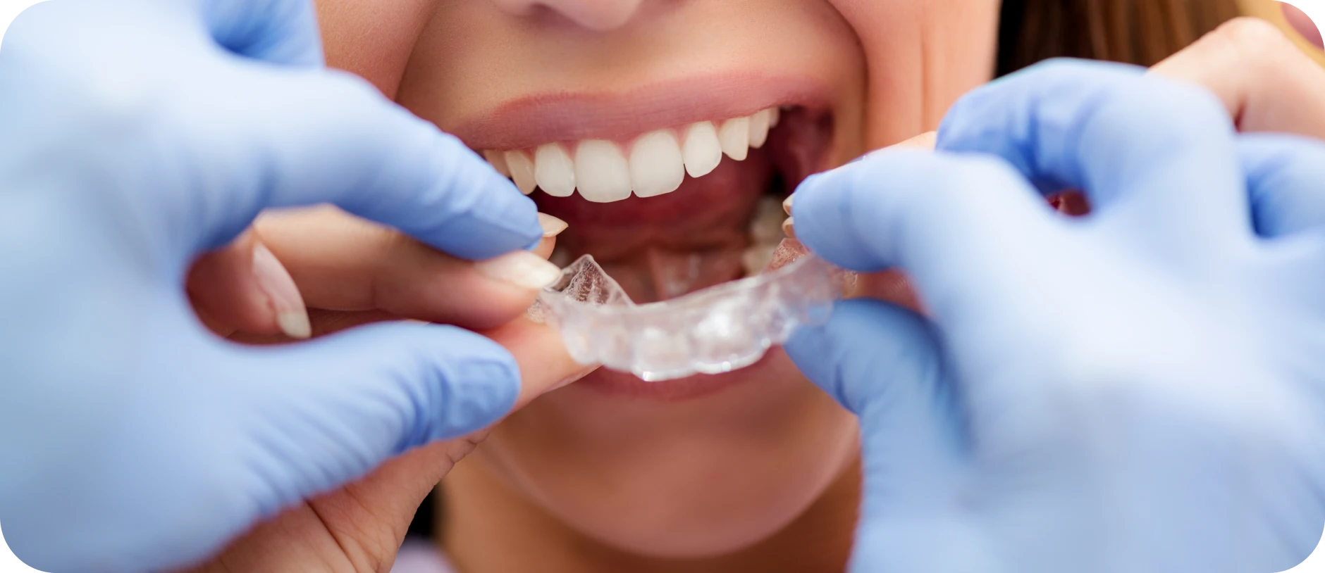 appareils adulte castelnau le lez appareils adulte castelnau le lez Aligneurs transparents Cabinet d'orthodontie du Dr SIMEONI