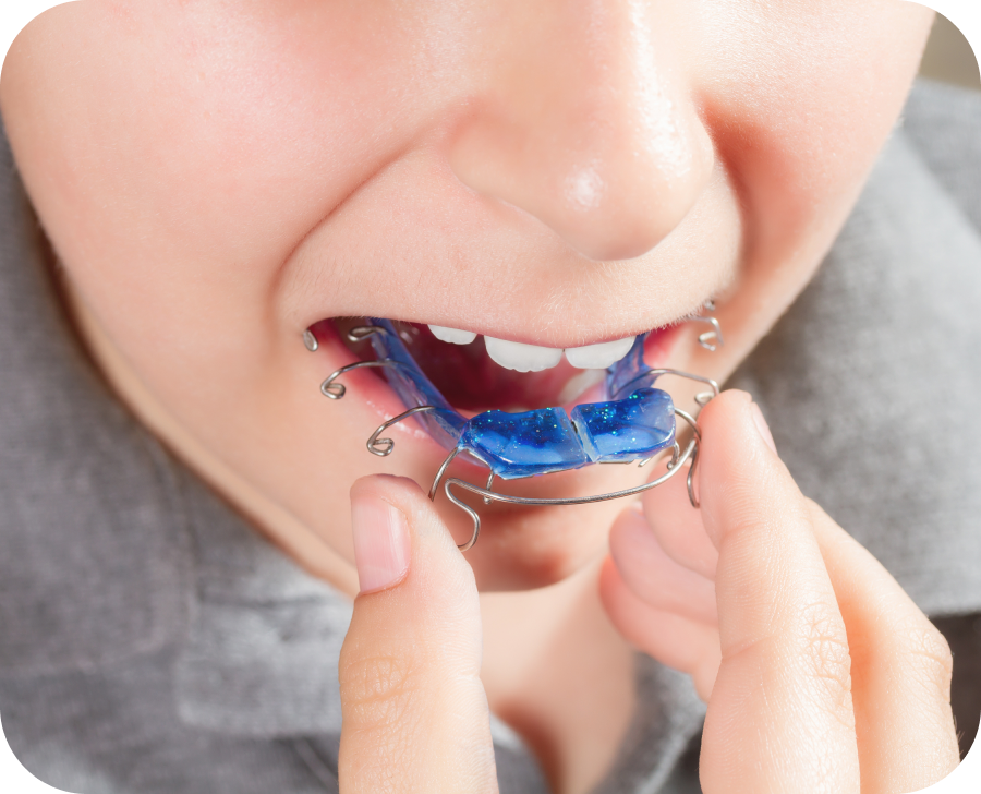 orthodontiste castries appareils amovibles Orthodontiste Castries Cabinet d'orthodontie du Dr SIMEONI